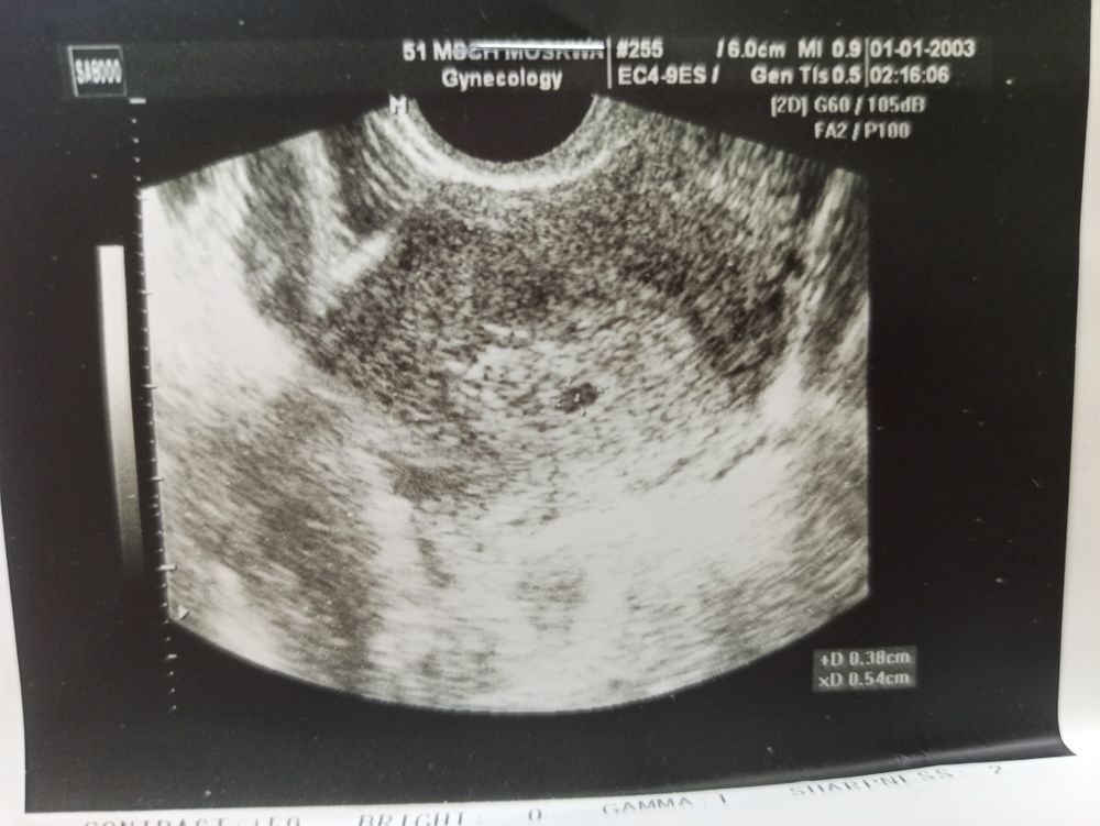 Анэмбриония (анэмбриональная беременность)