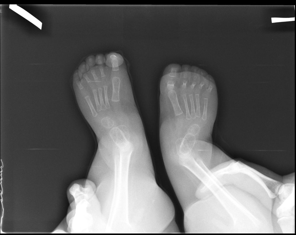 Рентген стопы фото. Рентген стоп у детей норма. Рентген стопы ребенка 10 лет норма. Рентген стопы ребенка в год норма. Стопа рентген норма у детей.