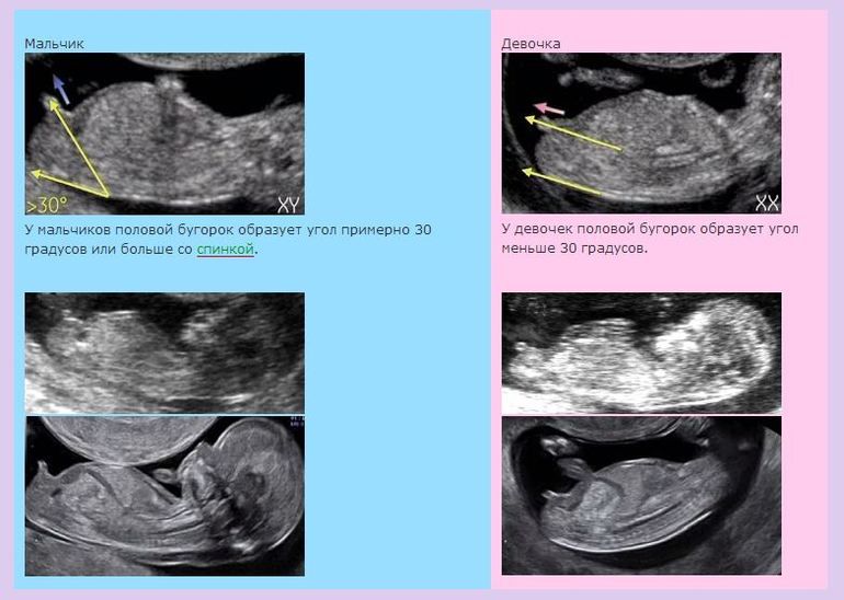 Мальчик или девочка? На каком сроке можно узнать пол ребенка
