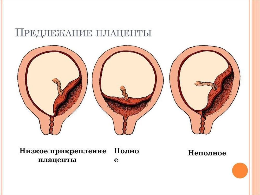 Расположение плаценты можно ли определить пол