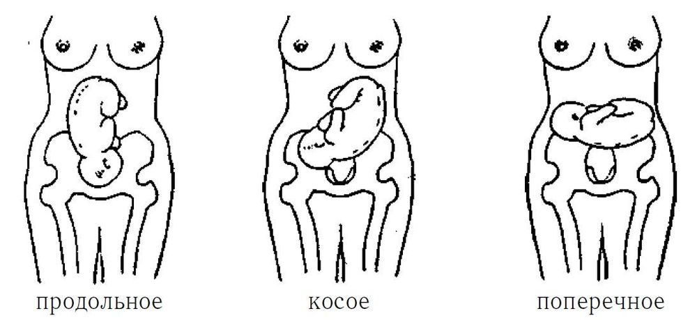 Как определить косое положение плода