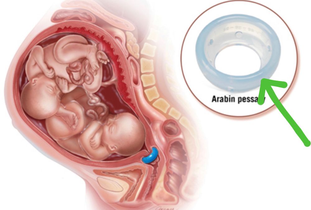 Фото пессария для беременных