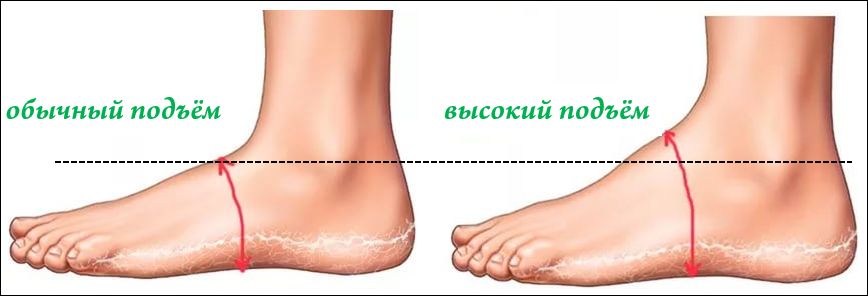 Высокий подъем стопы
