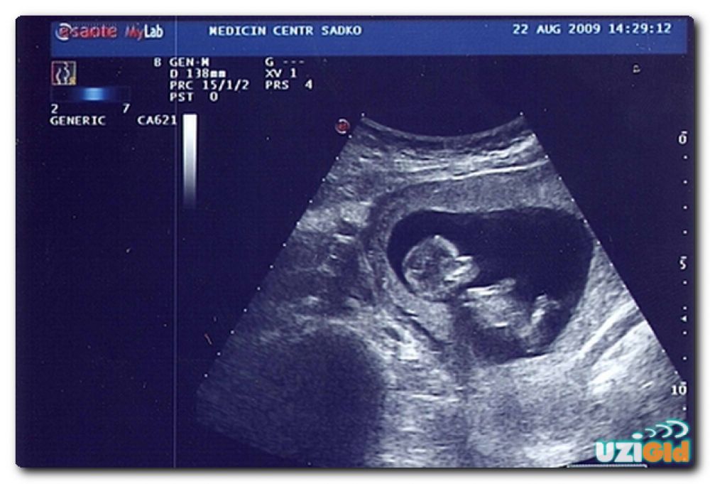 Как выглядит скрининг на 12 неделе беременности фото