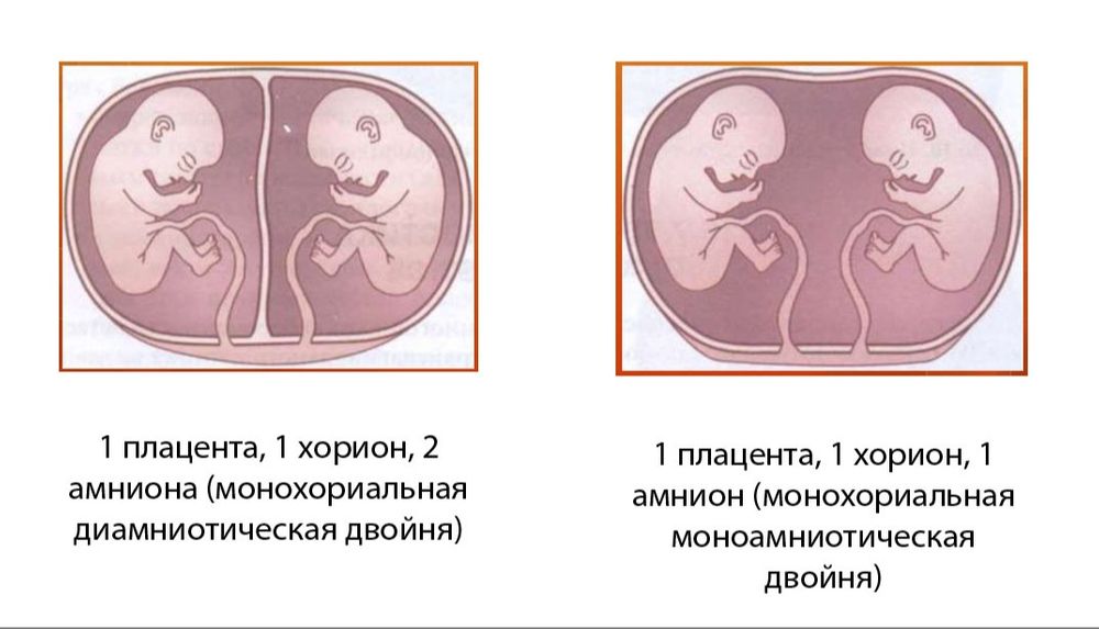 Монохориальная двойня