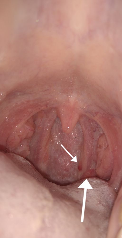 Пузырьки на задней стенке горла - Отоларингология - - Здоровье цветы-шары-ульяновск.рф