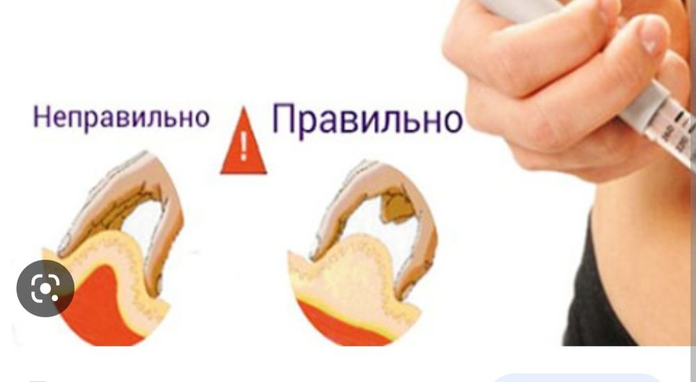 Подкожно в живот техника выполнения. Укол подкожно в живот. Подкожная инъекция в живот Клексан.