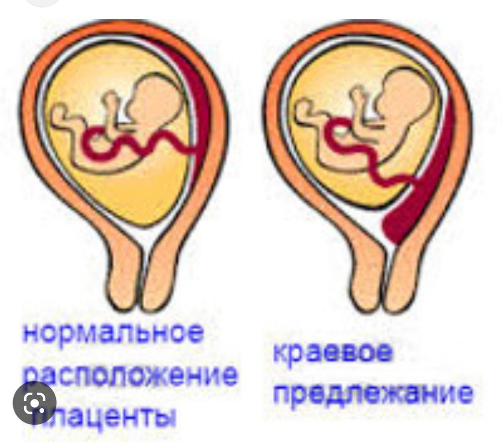 Краевое прикрепление пуповины к плаценте — 18 ответов