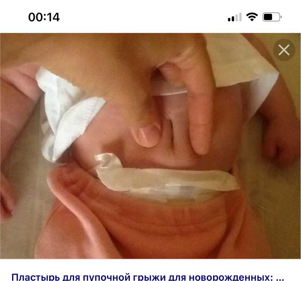 Пупочная грыжа — 15 ответов | форум Babyblog