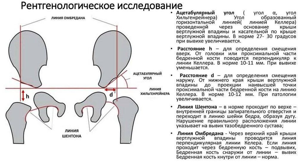 Дисплазия тбс рентген схема определения