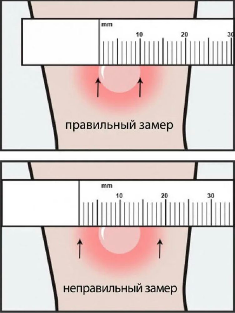 Проба Манту: почему нельзя мочить, оценка результата