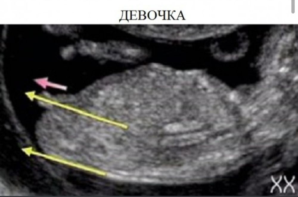 Узи на 12-13 неделе беременности скрининг пол ребенка. 13 неделя беременности на узи пол ребенка. Узи на 13 неделе беременности пол ребенка. 12 недель беременности пол ребенка по узи мальчик. 13 неделя беременности на узи пол ребенка.