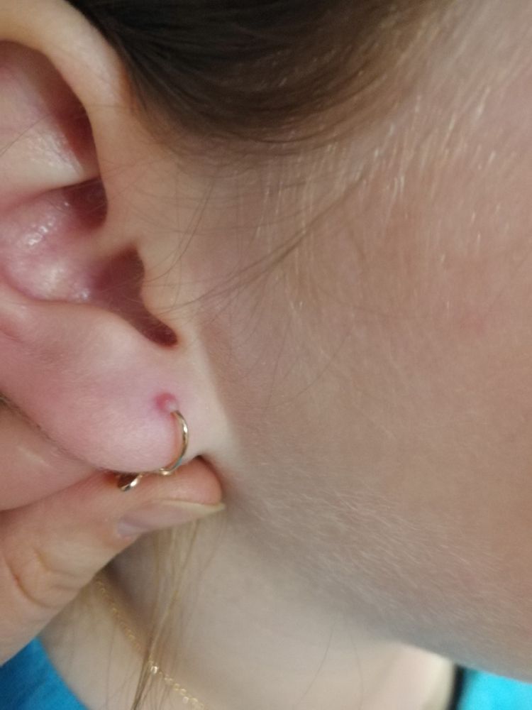 Шишка на хряще уха, воспаление после пирсинга — лечение