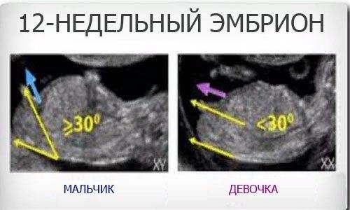 Узи беременность девочка или мальчик