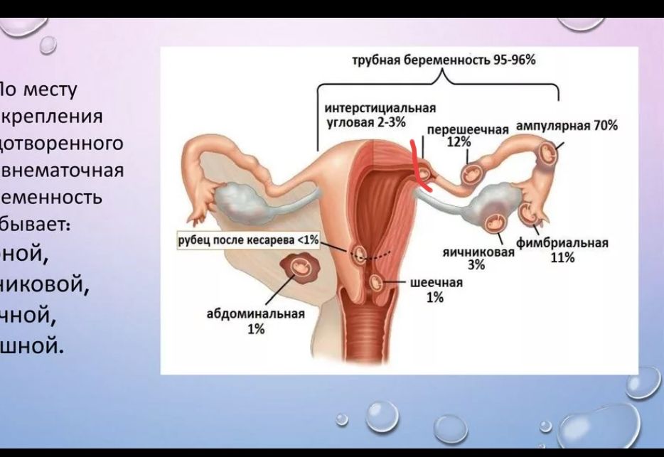 Эктопическая беременность. Внематочная беременность Трубная беременность. Эктопическая Трубная беременность. Места локализации внематочной беременности. Фимбриальная внематочной беременности.