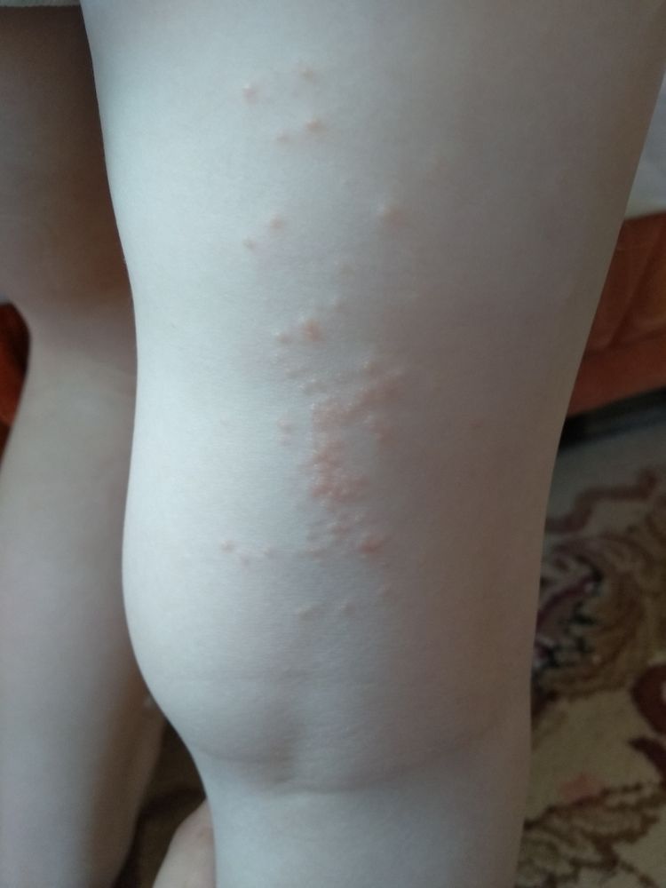 Гнойно-воспалительные заболевания кожи и подкожной клетчатки у детей