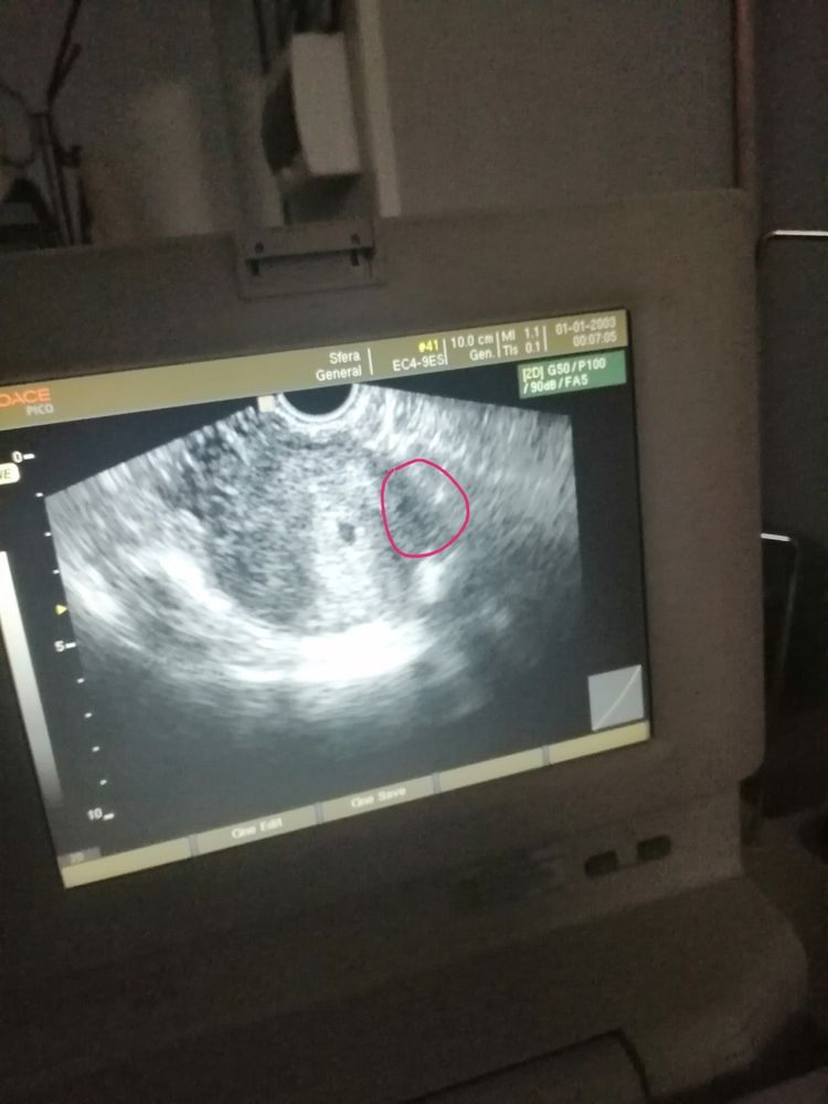 Узи возможна ли двойня? — 11 ответов