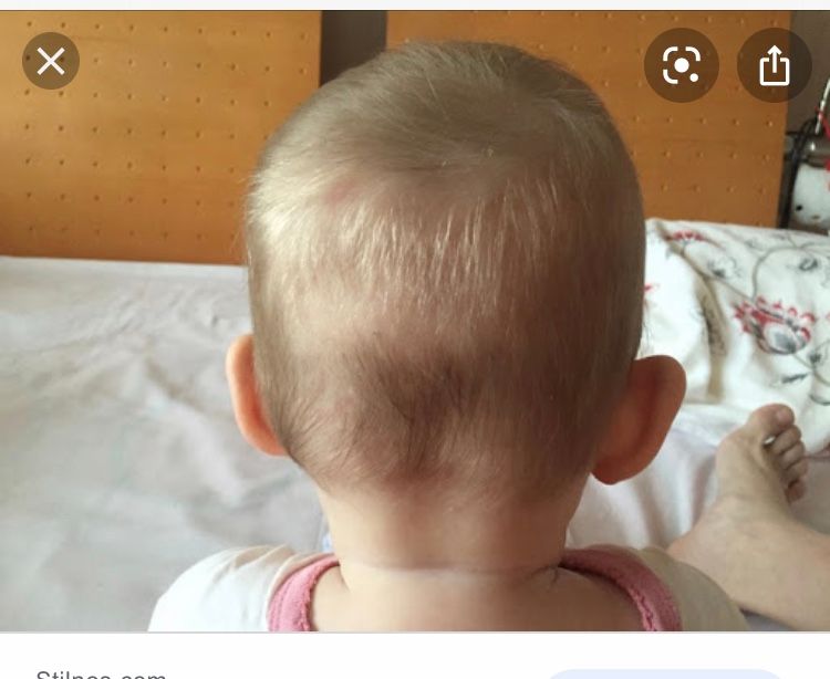 Почему растет голова ребенка. Лимфоузлы на голове у грудничка. Шишка на голове у младенца. Шишки на затылке головы у ребенка.