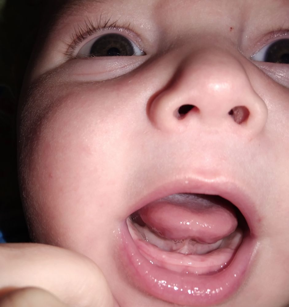 Почему у новорожденных слюни. Прорезывание зубов у младенцев. Прорезывание нижних зубов.