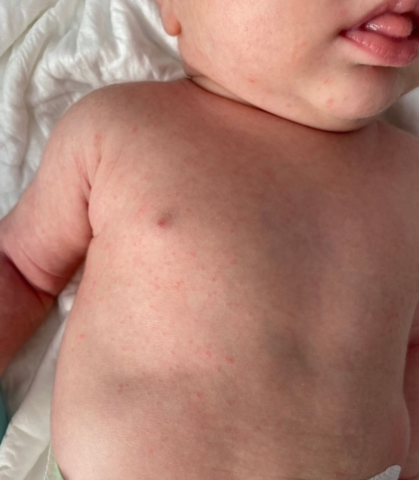 Кожные высыпания у малышей − противопоказания к вакцинации