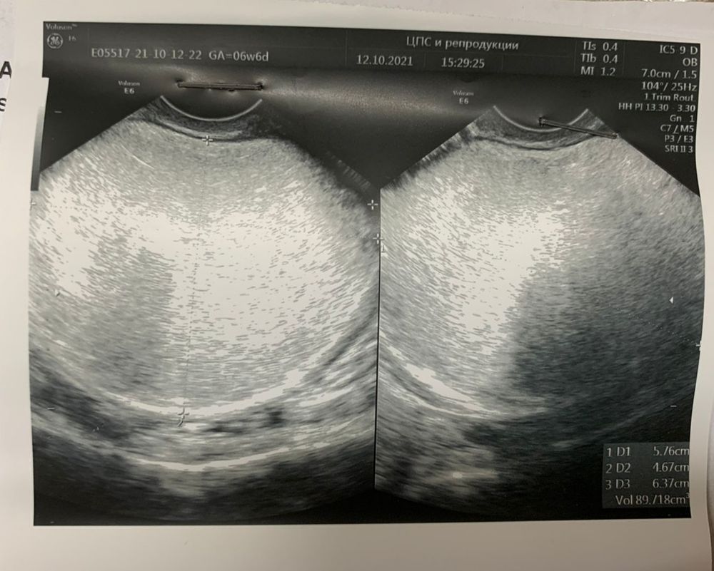 Дермоид яичника у беременной