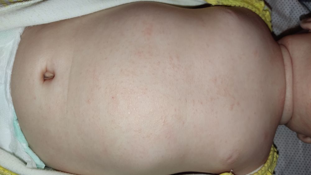 Пузыри (пузырек) на коже. Лечение в Новосибирске