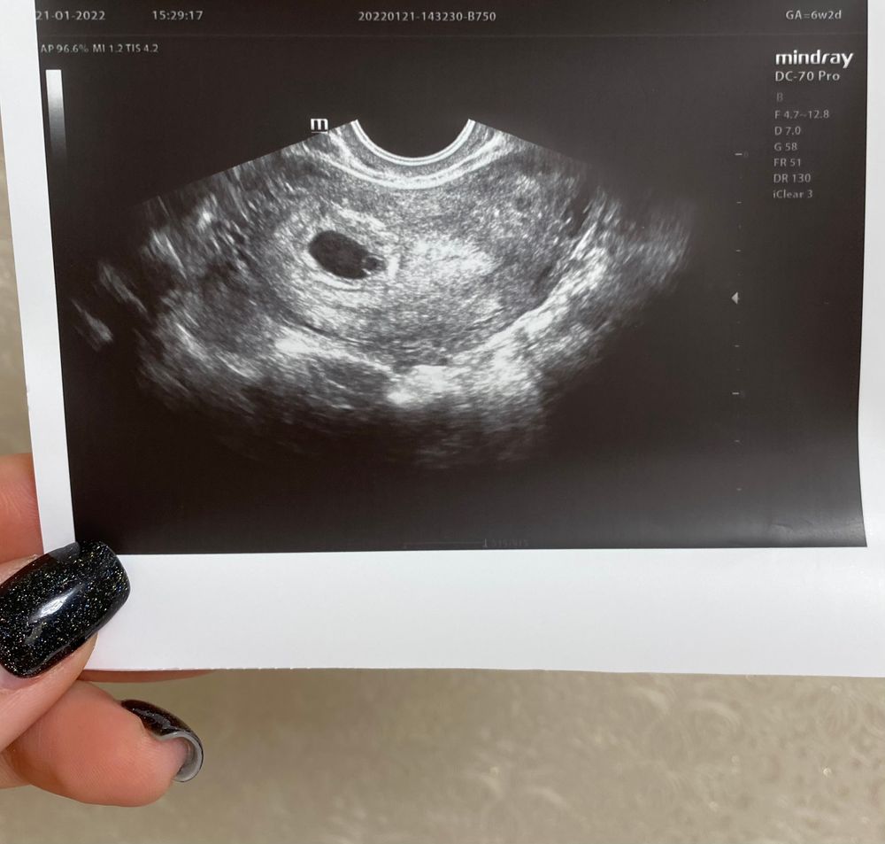 беременность 1 неделя и выделение с грудей фото 111