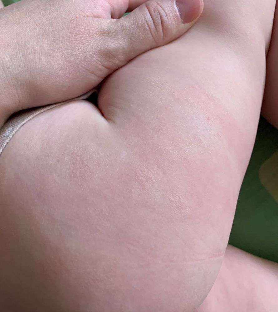 Шершавые пятна на теле у ребенка