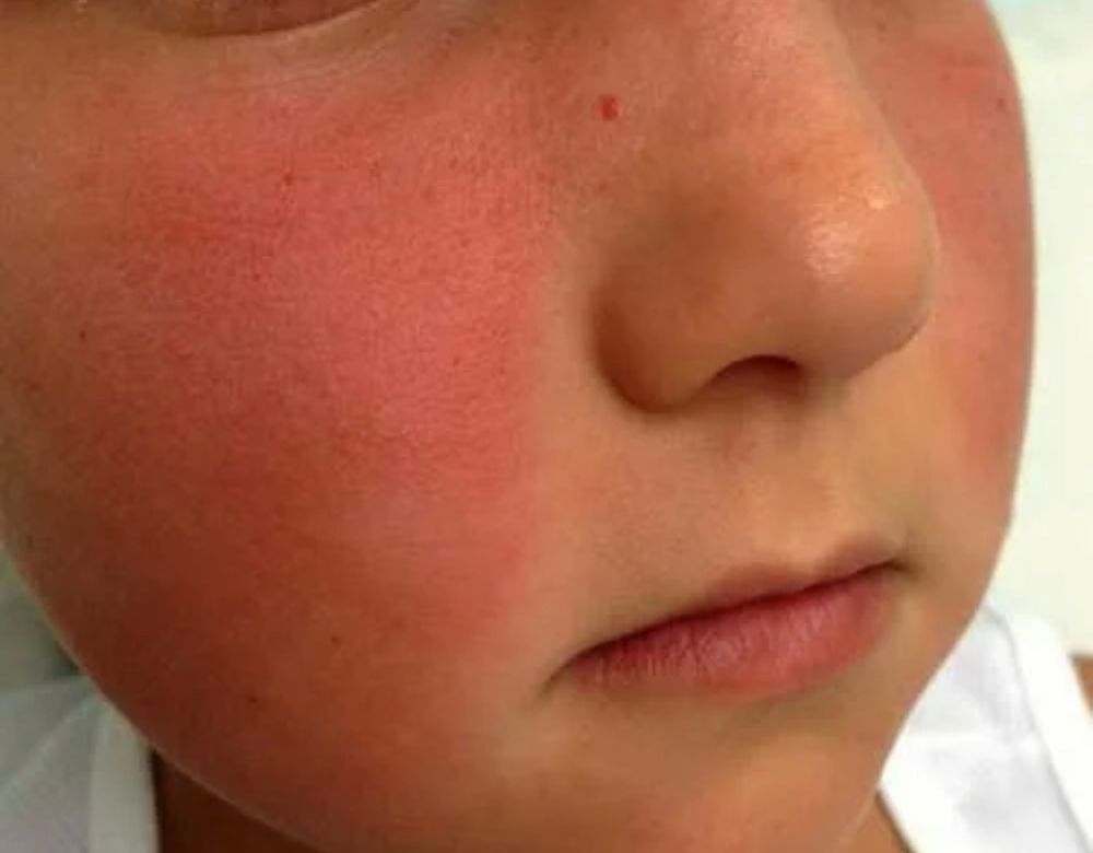 Осторожно! Аллергия на крем для лица! | Красота и уход | Дзен