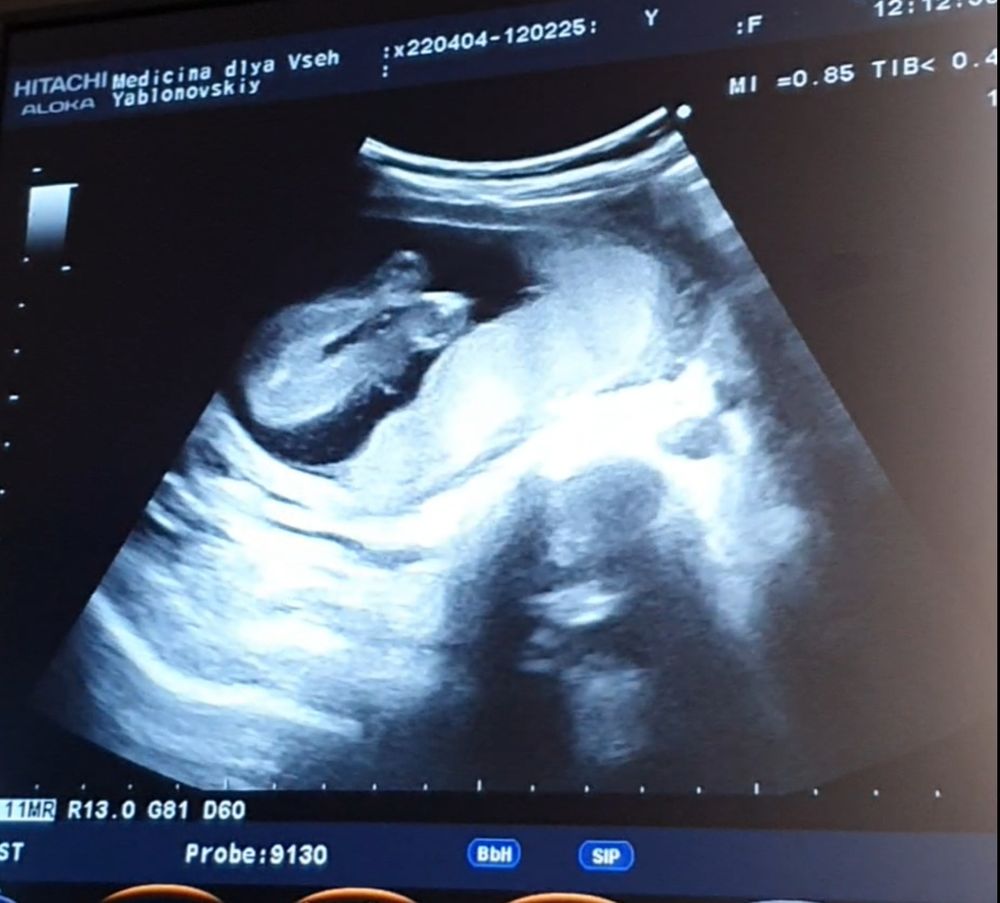 17-20 недели беременности