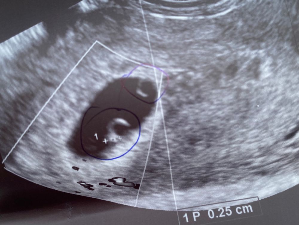 Замершая беременность - что это такое и что делать? — статья МЦРМ