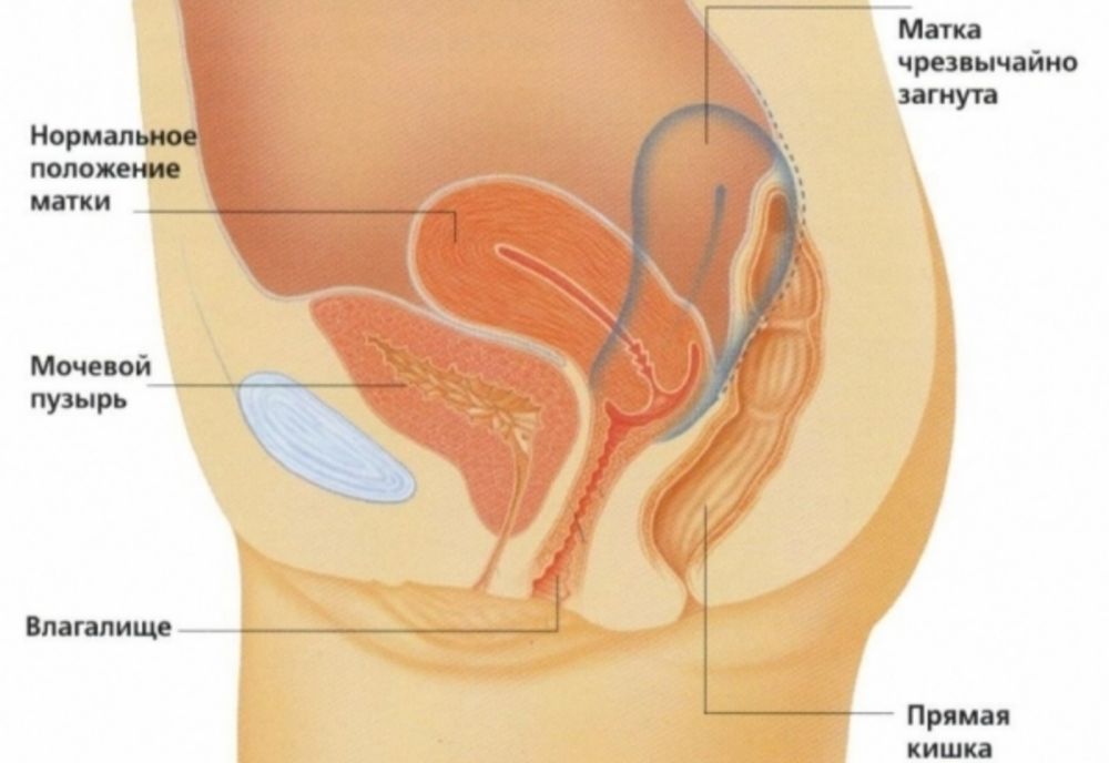 Лечение загиба матки кзади