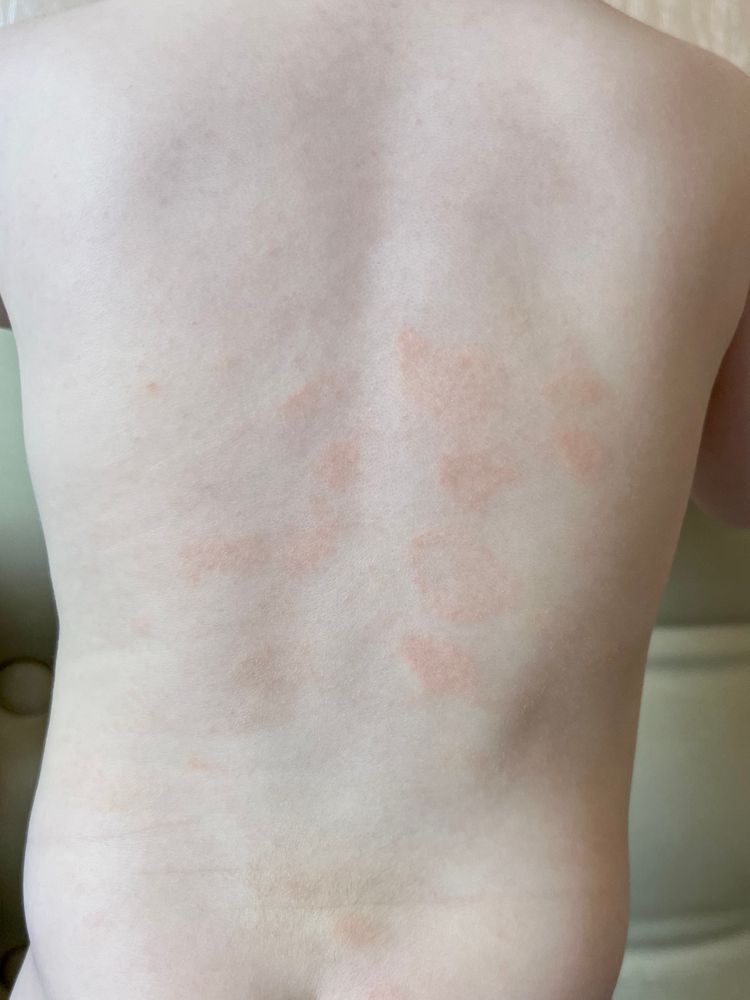 Розовые пятна на теле , аллергия? — 4 ответов | форум Babyblog