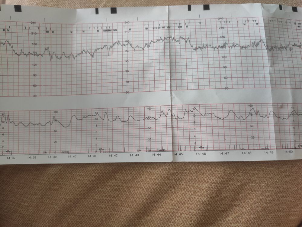 Сердцебиение плода на ктг