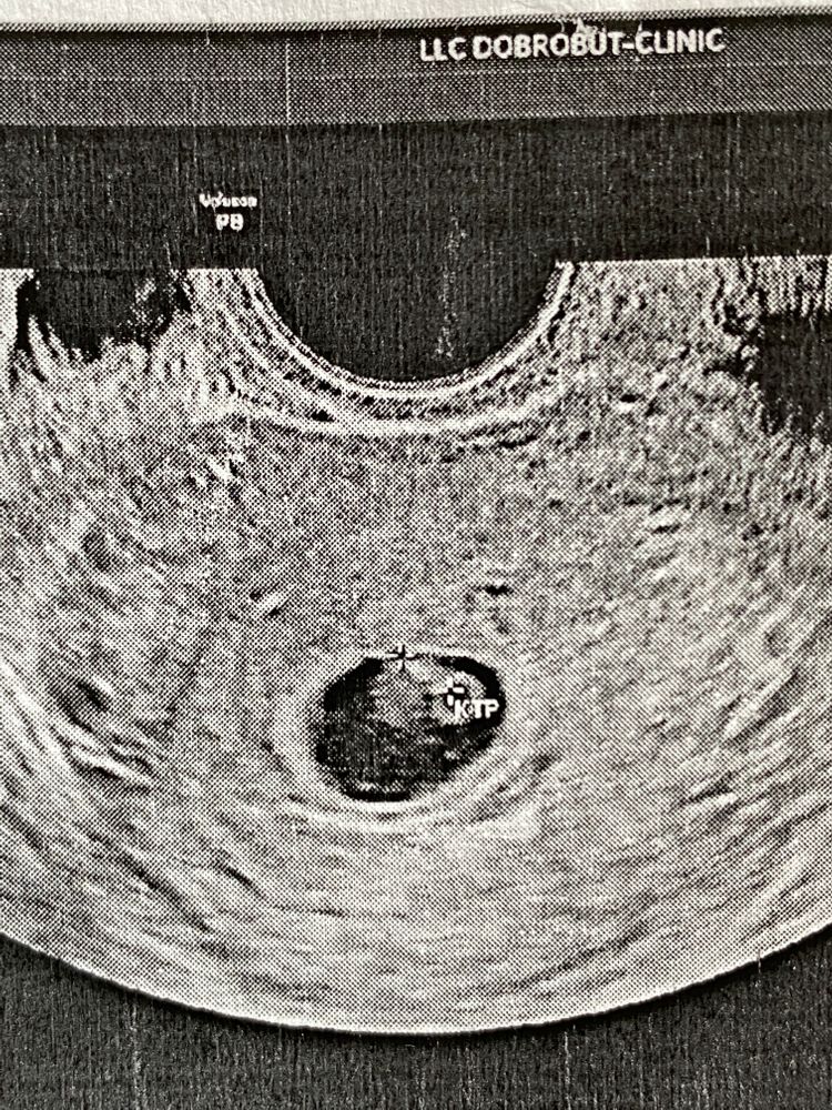 9 недель беременности коричневая мазня