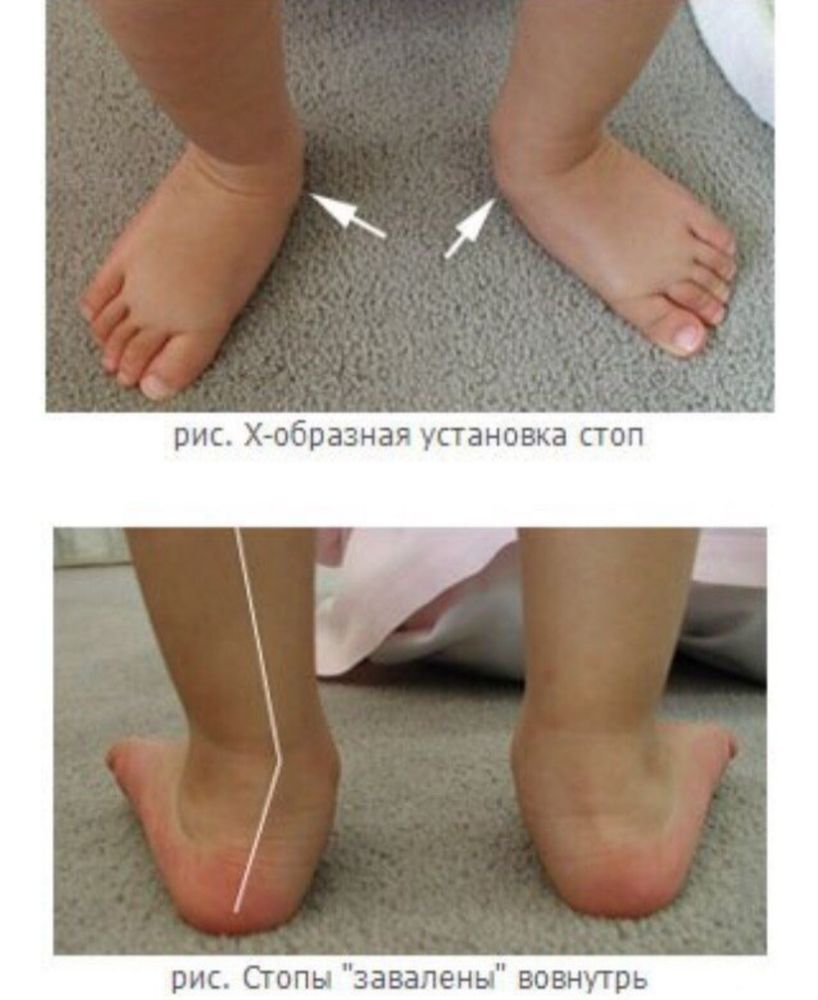Нога ребенка 1.5 года
