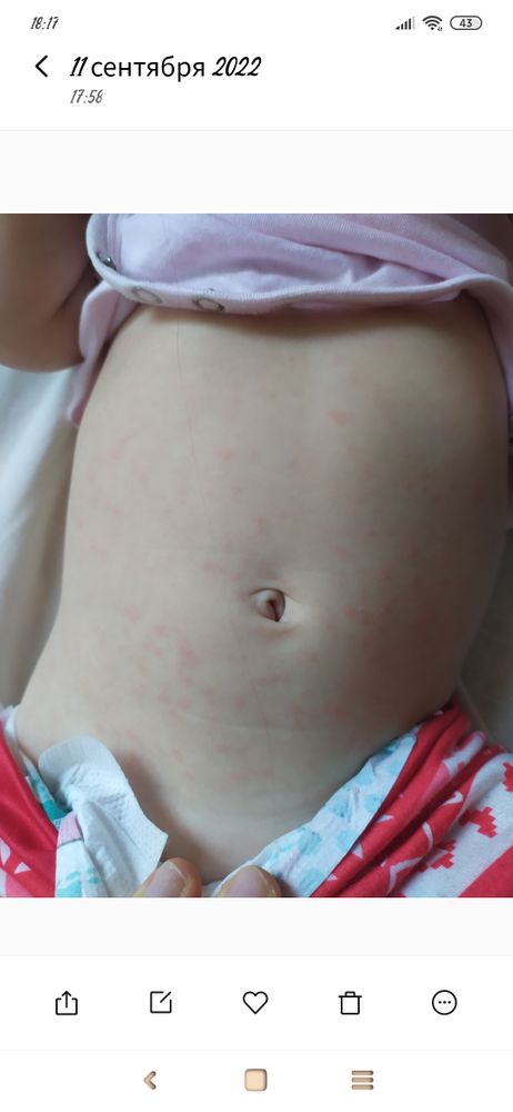6 детских болезней с сыпью: как не запаниковать и не пропустить серьезное