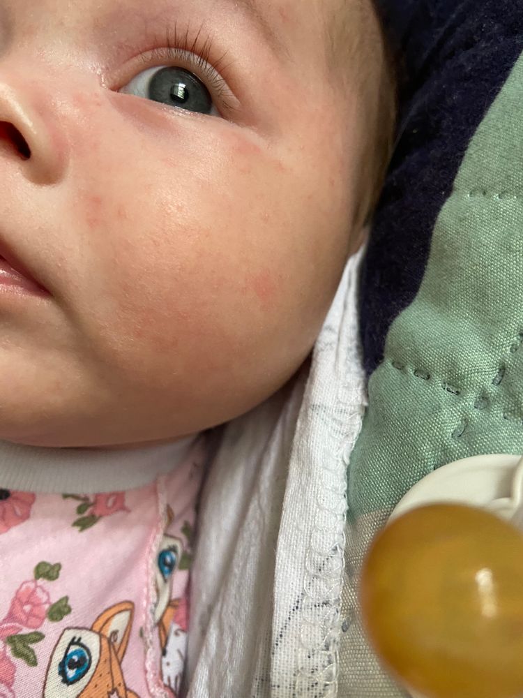 Как выглядит акне у детей Аллергия??? - 14 ответов форум Babyblog