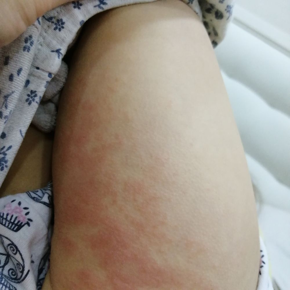 У женщины аллергия на сперму - nordwestspb.ru