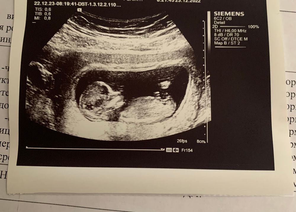 1 ый скрининг. Узи первый триместр беременности скрининг. Узи 1 скрининг синдром дауна при беременности. Скрининг 11 недель беременности. Узи первый скрининг беременности.