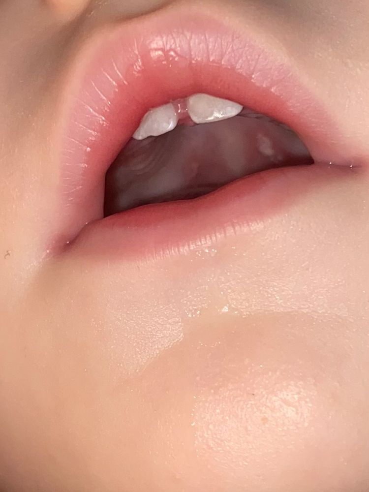 Белые точки на миндалинах у ребенка