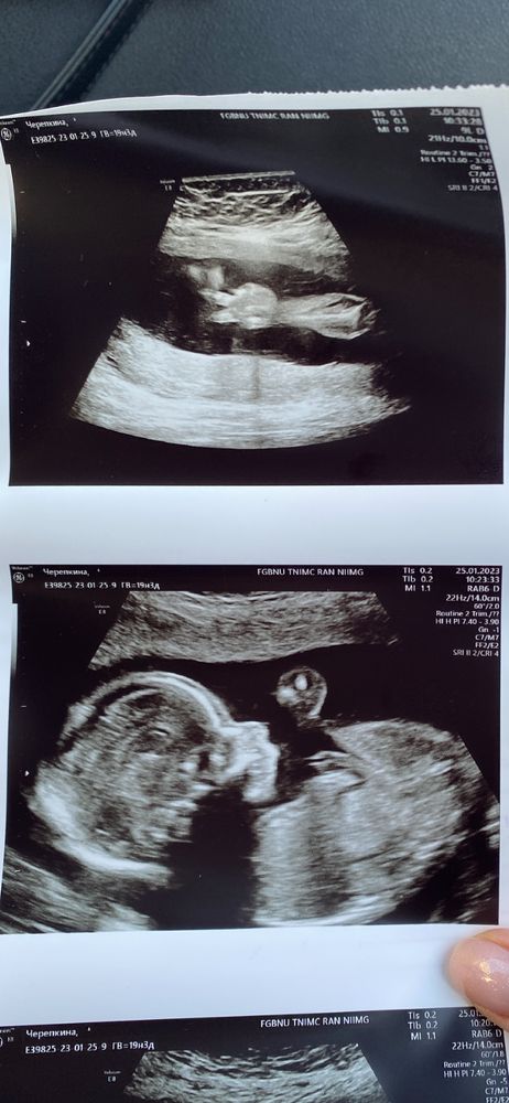 Узи 12-13 недель беременности. Бебиблог скрининг. Скрининг. Бебиблог скрининг. Узи скрининг.