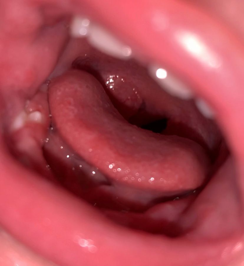 Симптомы заболеваний горла