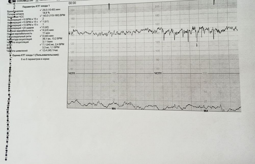 Ктг при беременности баллы. КТГ. Сомнительная КТГ. Кардиотокография / КТГ / цена.
