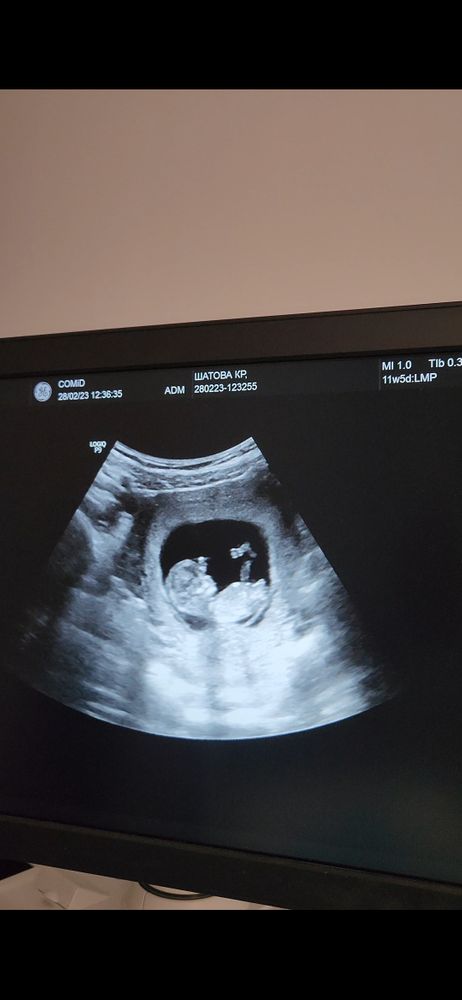 Узи плода первый скрининг. Бебиблог скрининг. Узи первый скрининг мальчик. Пренатальный биохимический скрининг 1 триместра. Бебиблог скрининг.