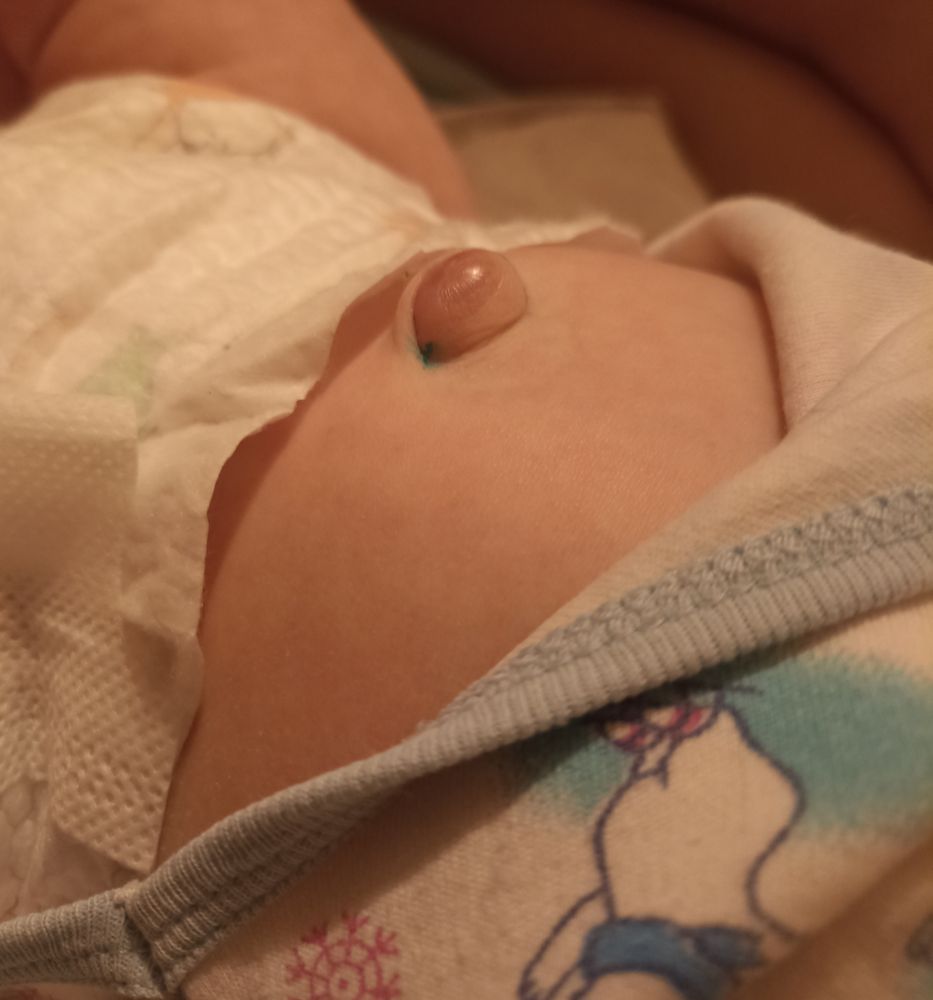 Пупочная грыжа у ребенка: как выглядит, когда нужна операция, лечение, фото, признаки