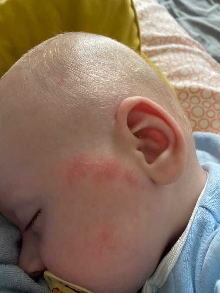 Аллергия лекарственная у детей – статьи о здоровье