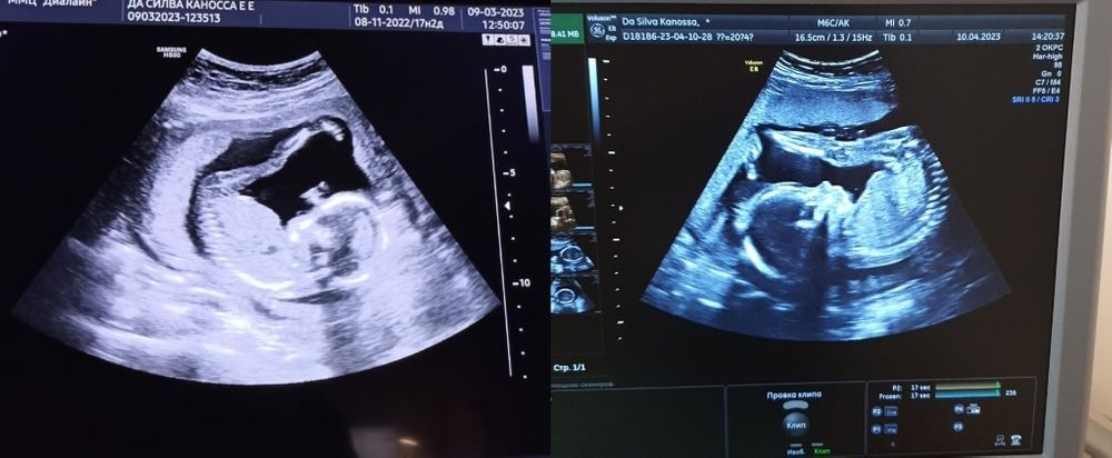 возрастной риск при скрининге 1 триместра 1:536. 2 скрининг нормы. 2 скрининг волгоград. 2 скрининг волгоград. второй скрининг при беременности 20 недель узи.