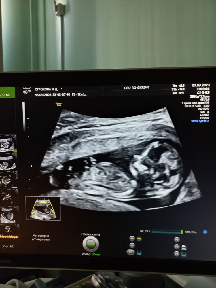 второе скрининговое узи 20 недель. скрининг плода в 20 недель беременности. узи скрининг беременных. скрининг беременных. 2 ой скрининг.