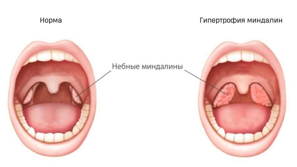 Удаленные Гланды Фото